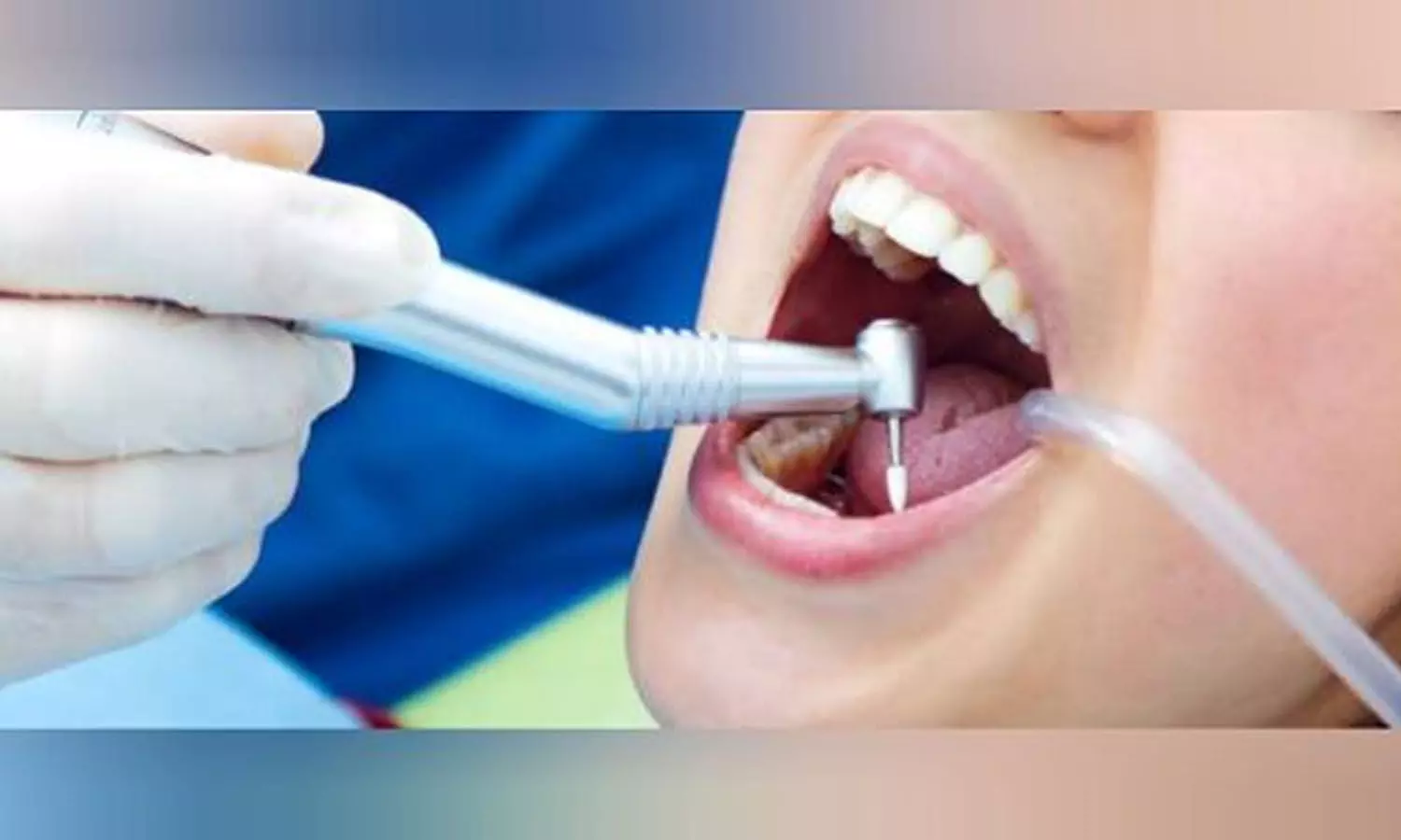 Clove Dental asked to pay Rs 2.50 lakh, interest to patients year-long agony post-root canal